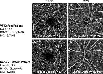 Elevated pulse pressure correlated with reduced retinal peripapillary capillary in thyroid-associated ophthalmology with visual field defect